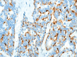 Chromogranin A 神経分泌がんの免疫染色像
