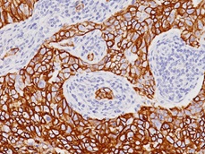 Cytokeratin 7 乳がんの免疫染色像