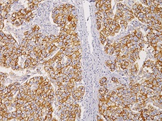 E-Cadherin(RM) 乳管がんの免疫染色像