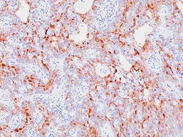 S100P 膀胱がんの免疫染色像