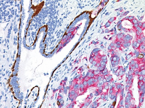 抗CK5/14 + p63 + P504S抗体を用いた前立腺がんおよび前立腺上皮内腫瘍の免疫染色画像