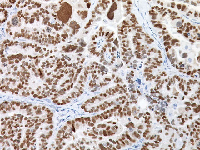 抗PAX8抗体の漿液性卵巣腺がん組織の染色像