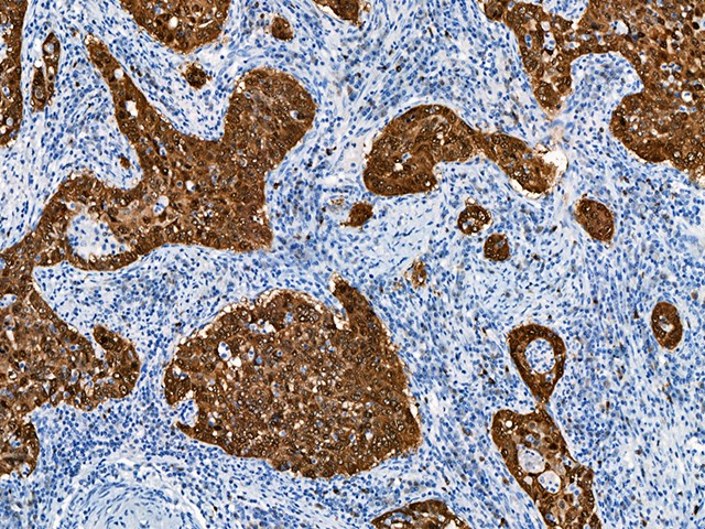 抗p16-INK4a抗体の子宮頸部扁平上皮がん免疫染色像