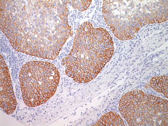 抗DSG3抗体を用いた肺扁平上皮がんの免疫染色像