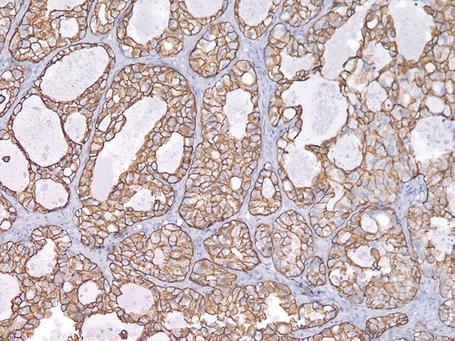 抗CK7抗体を用いた乳がんの免疫染色像