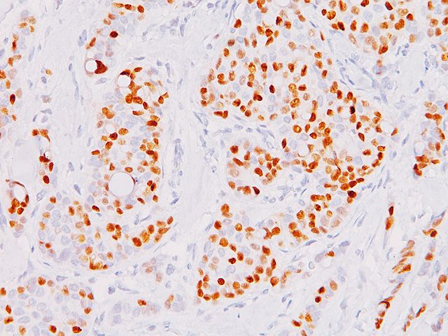 抗Progesterone Receptor (PR) 抗体による乳がん組織染色像