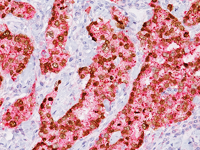 ヒト肺腺がん組織の免疫染色像