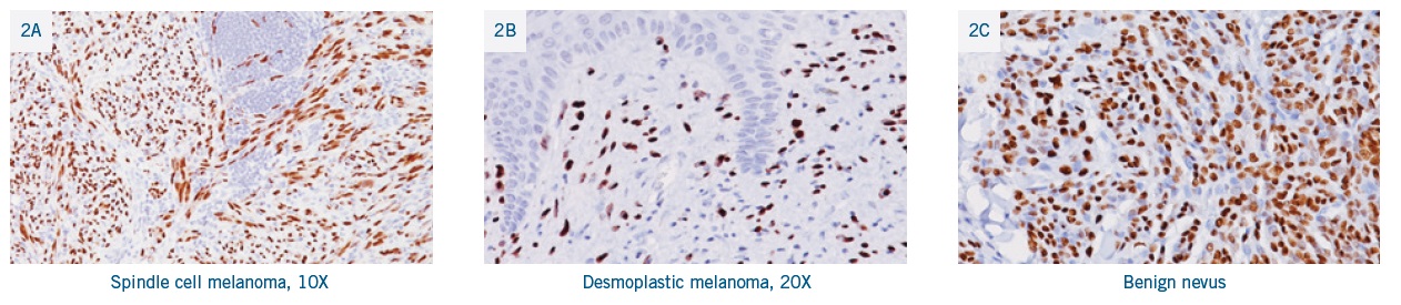 抗SOX10抗体を用いた紡錘細胞および線維形成性黒色腫の免疫染色画像