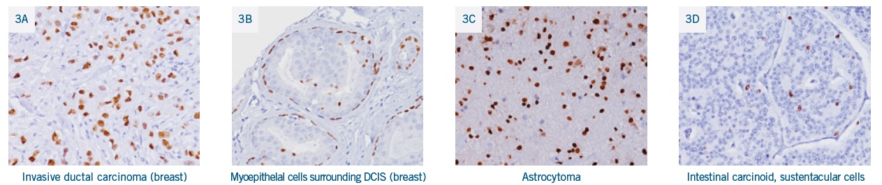 抗SOX10抗体を用いた様々な腫瘍の免疫染色画像