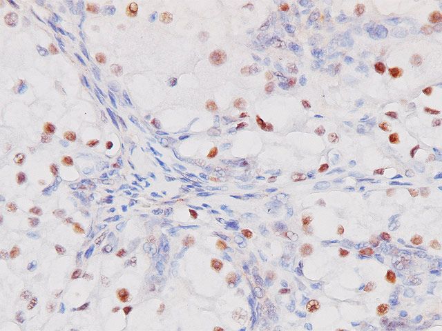 抗PAX8抗体を用いた腎明細胞がんの免疫染色