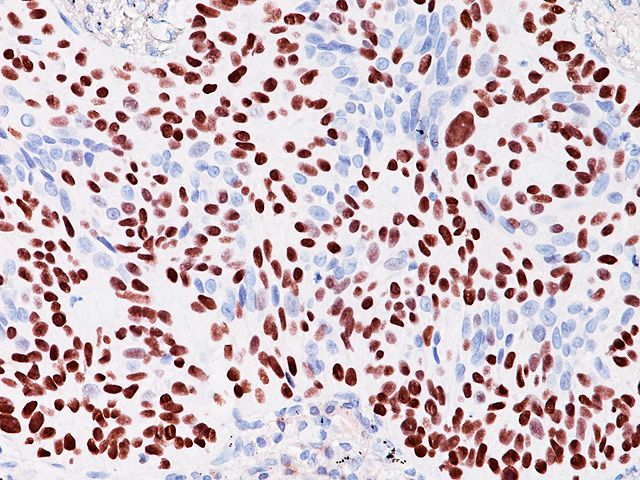 抗p40抗体（#ACR3030）を用いた肺扁平上皮がん組織の免疫染色像
