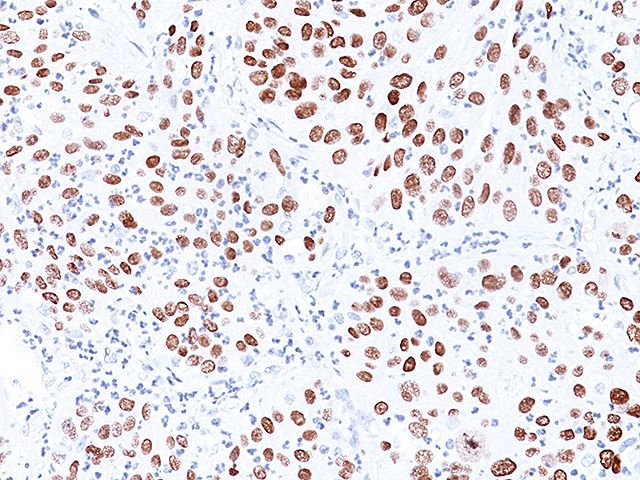 抗p40抗体（#ACR3066）を用いた肺扁平上皮がん組織の免疫染色像