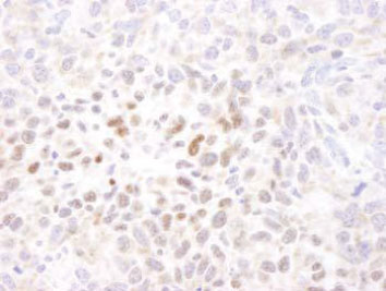 マウス扁平上皮癌組織中のマウスHIF1-αの免疫染色像