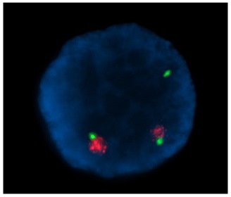 X染色体トリソミーのヒト細胞でのXISTの検出