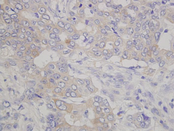 Fig. 1 IHC data of human pancreas cancer tissue (FFPE)