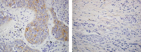 Fig.2 IHC data of human lung cancer tissue (FFPE). Lumican can be detected in cancer cell (Left) or stromal component (Right) at squamous cell cancer.