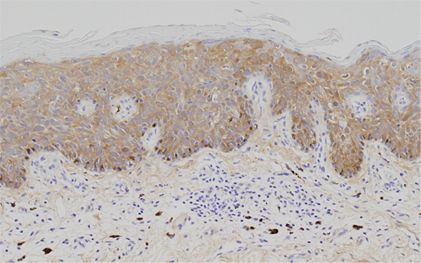 Fig. 4 IHC data from tissue sample of Bowen's disease patient. Lumican expression is detected in cytoplasm of cancer cells at epidermis.