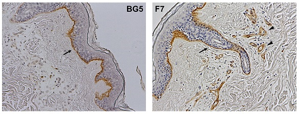 Fig.3  IHC image of skin cancer tissue in clone BG5 and F7