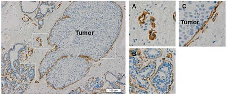 Fig.5 IHC image of breast cancer tissue in clone 12D