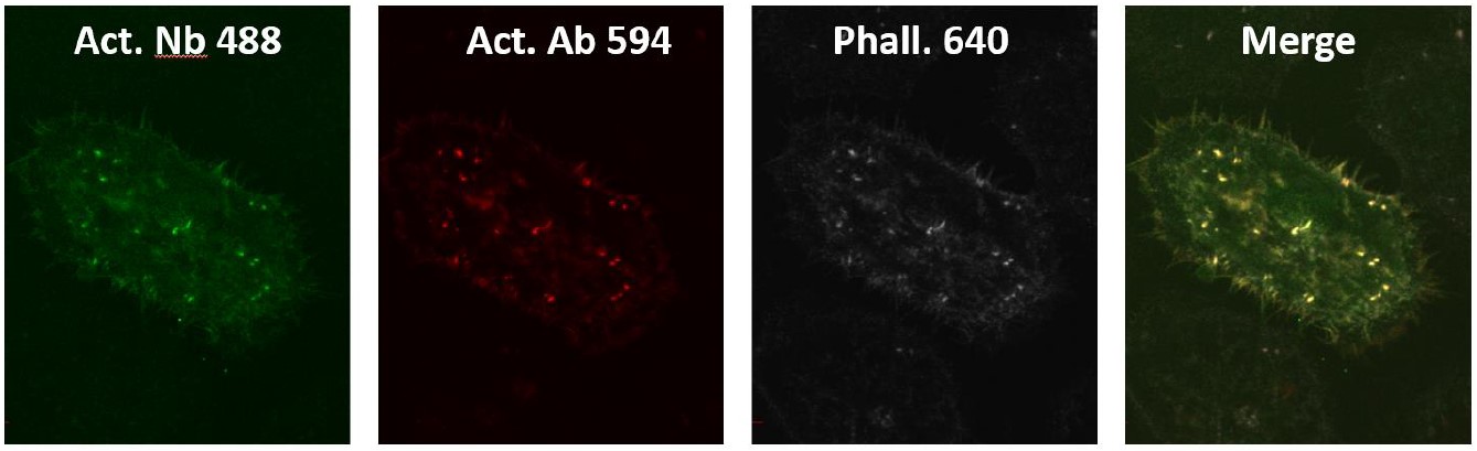 抗α-actinin4抗体 クローン：Nb64を用いた頭頸部扁平上皮癌（HNSCC）細胞の染色像