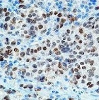 Melanoma Marker（メラノーママーカー）抗体 GTX12039を使用した染色画像