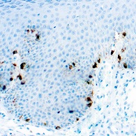 Melanoma Marker（メラノーママーカー）抗体 GTX20738を使用した染色画像