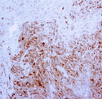 Melanoma Marker（メラノーママーカー）抗体 GTX20785を使用した染色画像