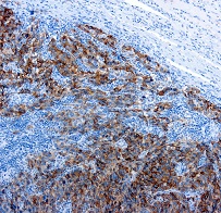 Melanoma Marker（メラノーママーカー）抗体 GTX20787を使用した染色画像