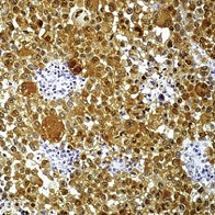 Melanoma Marker（メラノーママーカー）抗体 GTX24066を使用した染色画像