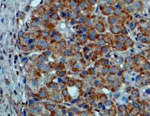 抗ヒトBRAF抗体（#REV-31-1042-00）を用いて染色したホルマリン固定パラフィン包埋黒色腫（メラノーマ）組織