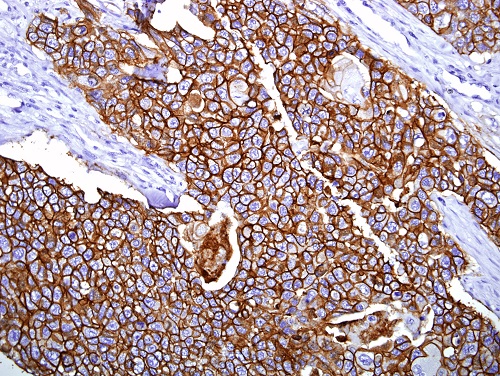 乳がん組織を抗HER-2抗体（#RM-9103 ）で免疫組織染色