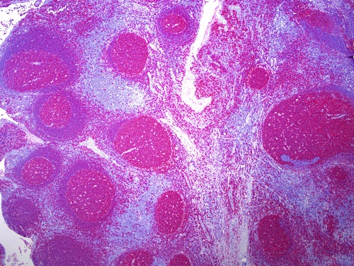 扁桃腺組織を抗CD20抗体（#MS-340 ）で免疫組織染色