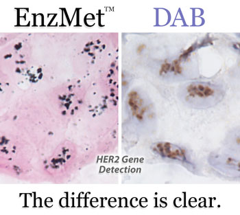 ヒト乳がん組織のHER2タンパク質の染色例1