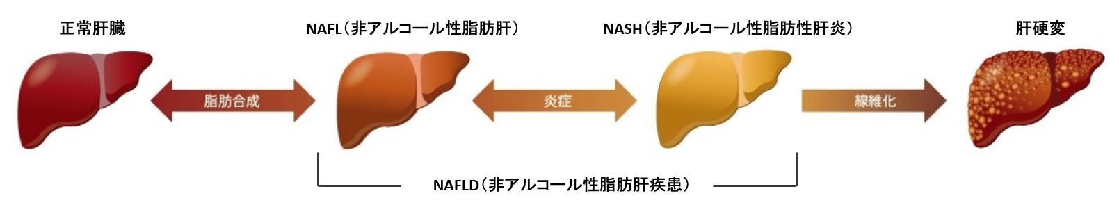 NAFLからNASH，肝硬変への進行