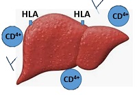 自己免疫性肝炎（AIH）を生じた肝臓イメージ
