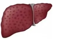 アルコール性肝炎を生じた肝臓イメージ
