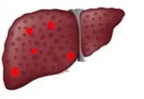 肝細胞癌を生じた肝臓イメージ