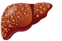 肝硬変を生じた肝臓イメージ