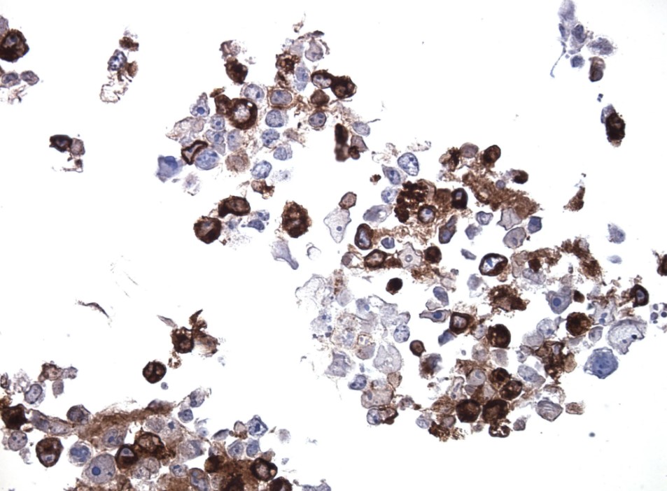 抗CTLA4抗体で染色したCTLA4過剰発現CytoSection（TS413631）の染色像