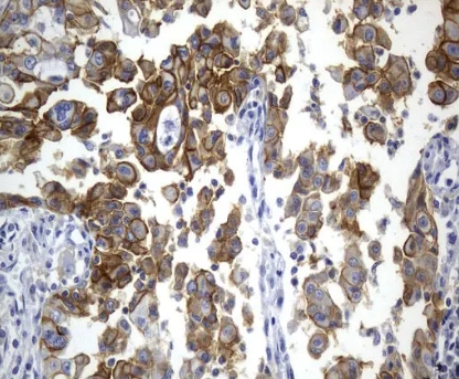 抗CD274（PD-L1）マウスモノクローナル抗体でヒト肺がん組織を染色した写真。