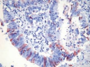 ヒト結腸がん組織の染色像