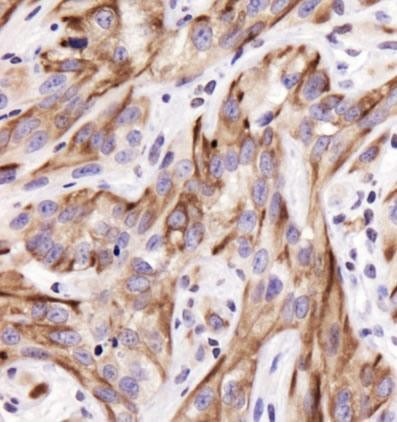 ヒト腎臓がん組織の免疫染色像