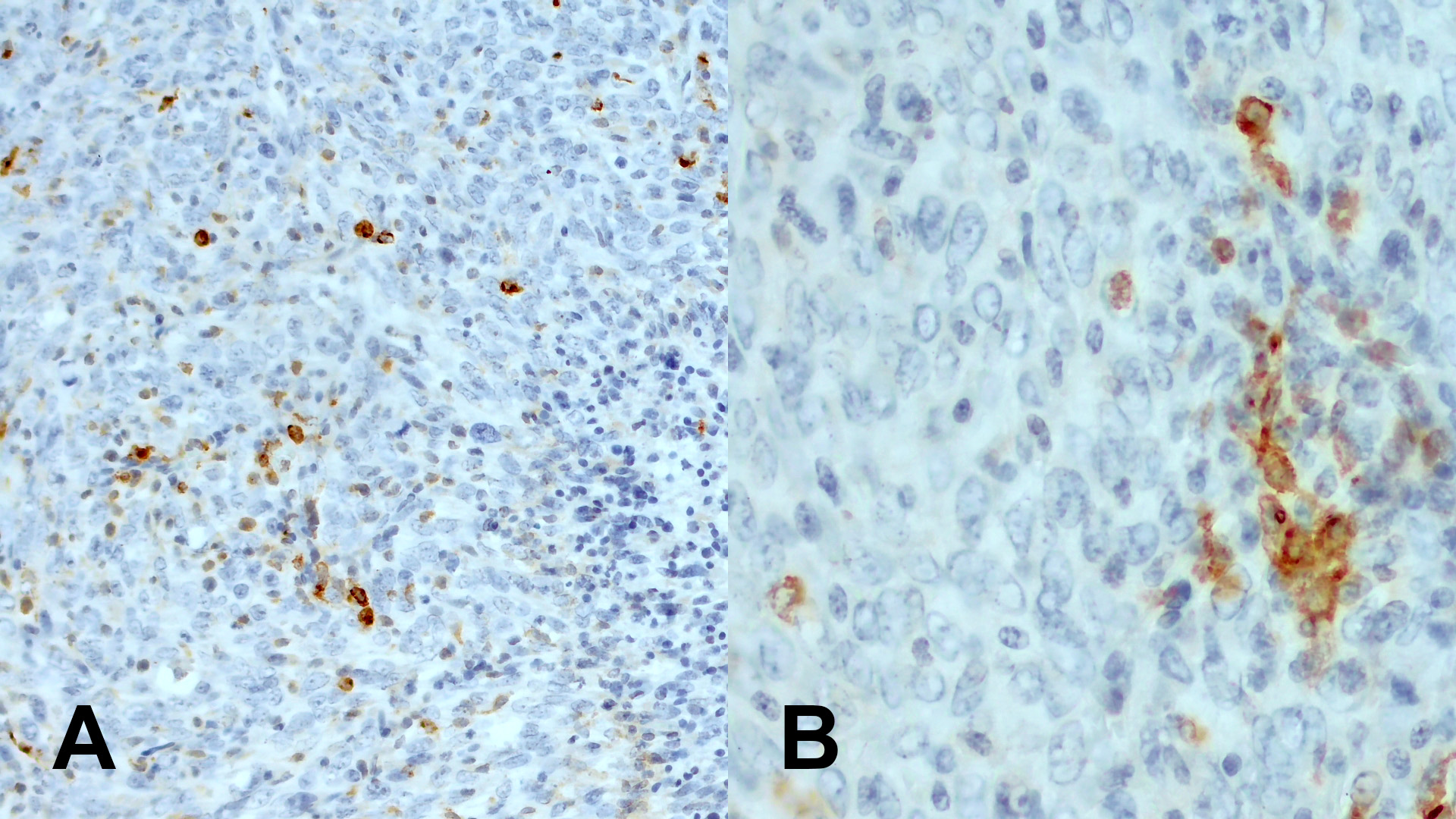 #HS-375003および#HS-375004を用いたマウス乳がん組織の免疫組織染色像