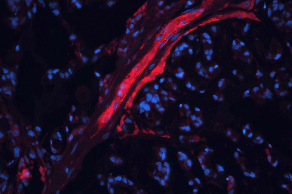 大腸がん組織の免疫蛍光染色像