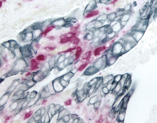 結腸がん組織の二重染色像
